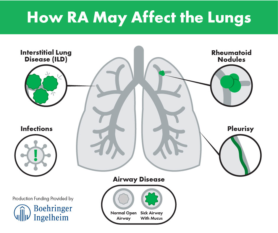 Rheumatoid Arthritis and Lung Disease